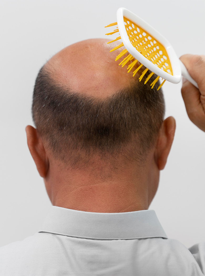 HairSmyrna-Saç Çözümleri-pic